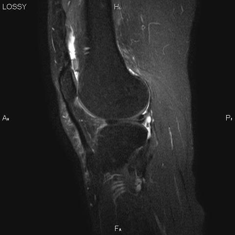 Разрыв мениска коленного сустава (фото)