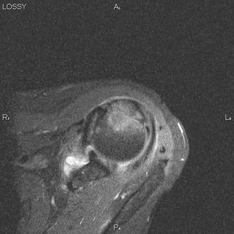 Перелом большого бугорка головки плечевой кости (фото)